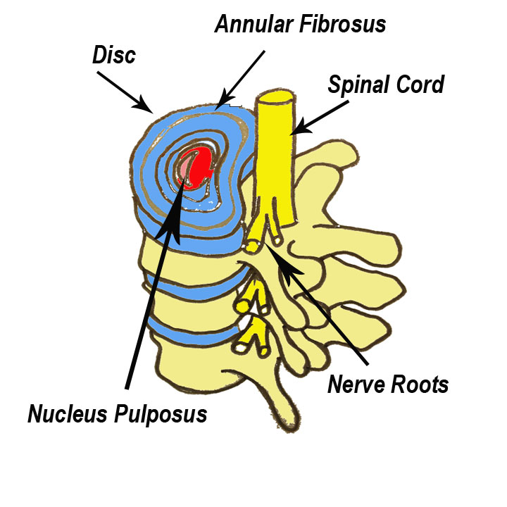 Sciatica is a symptom of pain down the leg and involves impingement of 