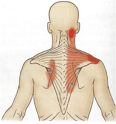 http://h2tmuscleclinic.com/wp-content/uploads/2015/01/trapezius-trigger-points1.gif