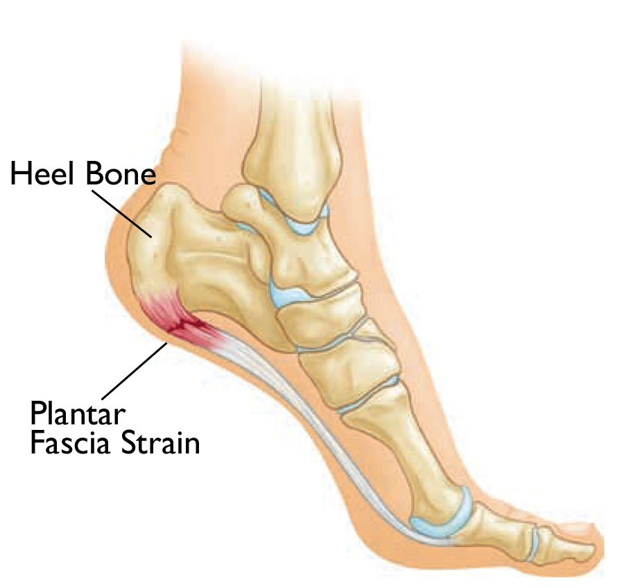 Plantar fasciitis and massage on sale therapy